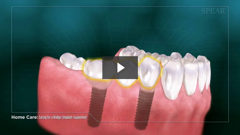 Caring for a Bridge (Implant-Supported)