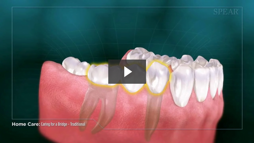 Caring for a Dental Implant