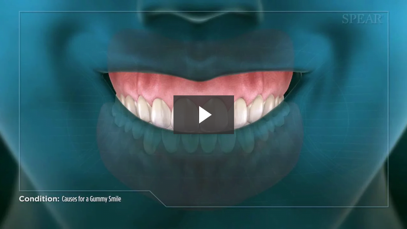 Causes for a Gummy Smile
