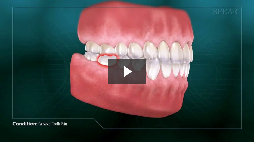 Causes of Tooth Pain