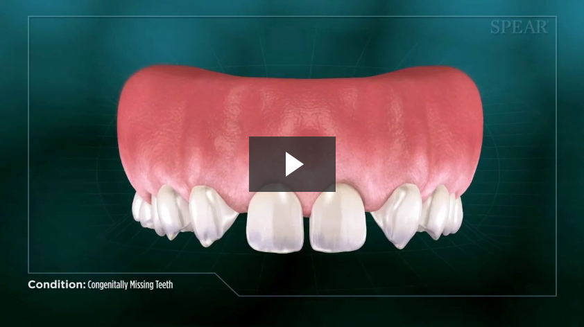 Congenitally Missing Teeth