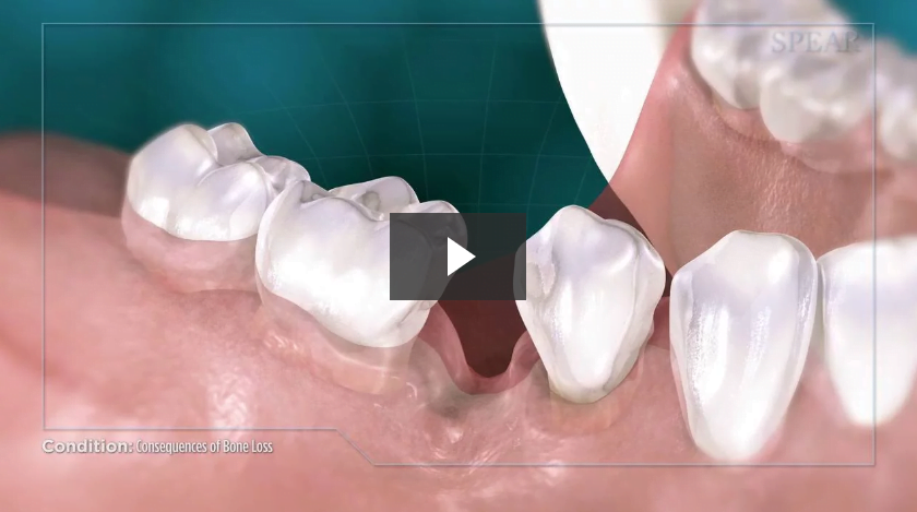 Consequences of Bone Loss