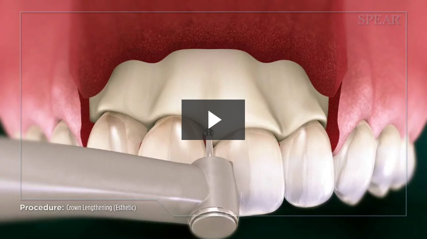 Crown Lengthening (Esthetic)