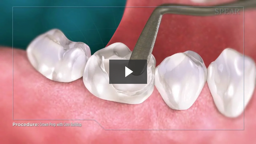 Crown Prep with Core Buildup