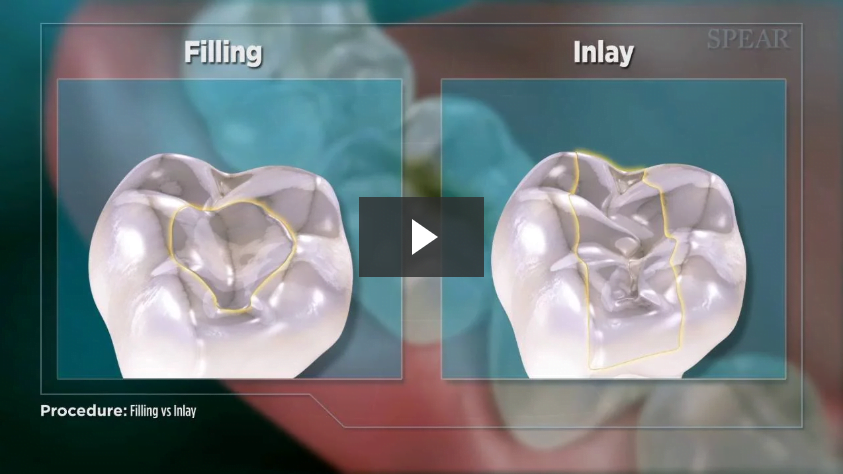 Filling vs Inlay