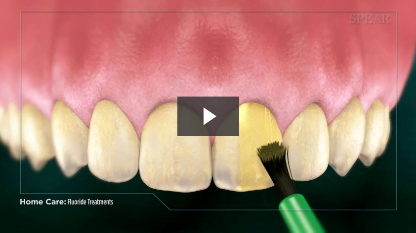 Fluoride Treatments