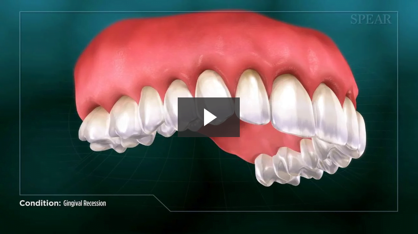Gingival Recession