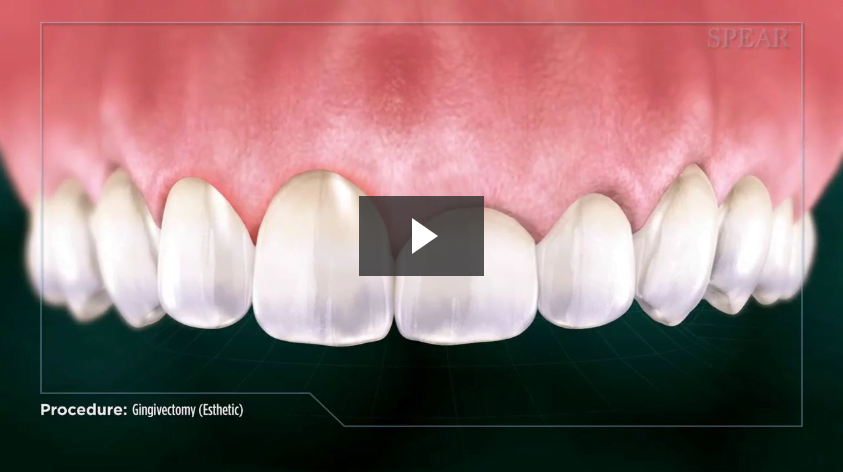 Gingivectomy (Esthetic)