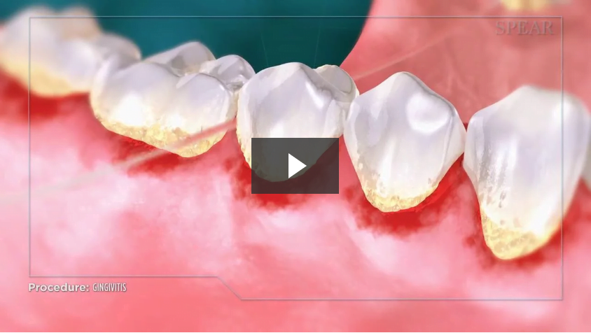 Gingivitis