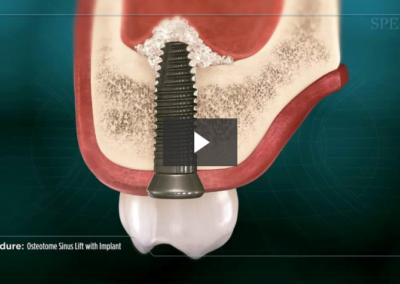Osteotome Sinus Lift with Implant Placement
