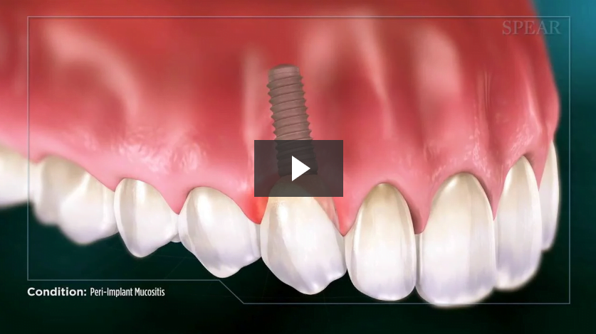 Peri-Implant Mucositis