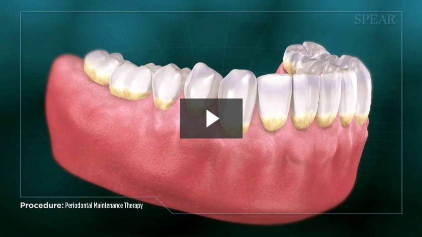 Periodontal Maintenance Therapy