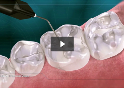 Pit and Fissure Sealants