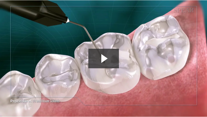 Pit and Fissure Sealants