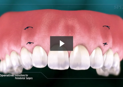 Post-Operative Instructions for Periodontal Surgery