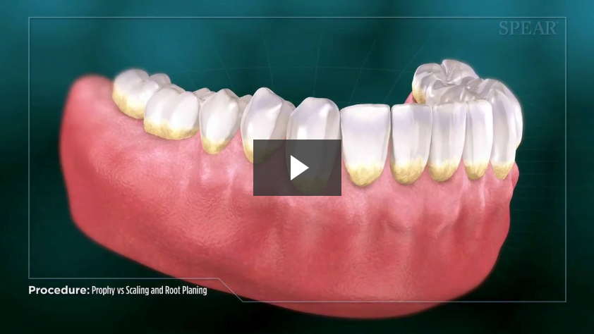 Prophy vs Scaling and Root Planing