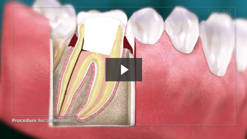 Root Canal Retreatment (No File)