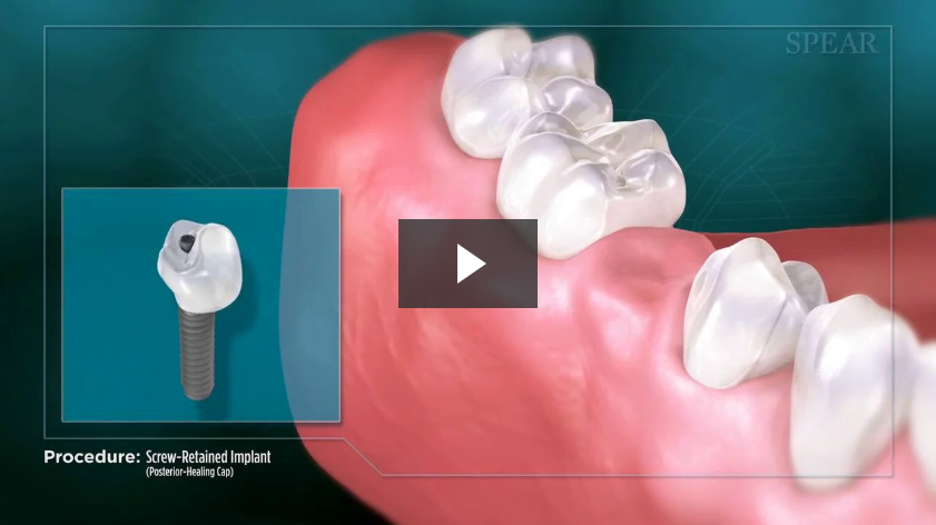 Screw-Retained Implant (Posterior- Healing Cap)