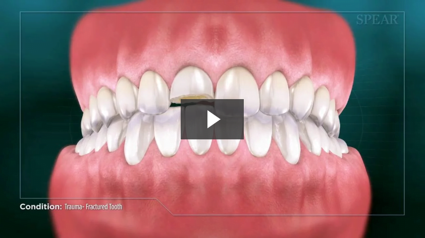 Trauma- Fractured Tooth