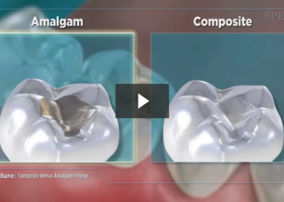 Composite Versus Amalgam Filling
