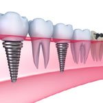 Dental Implant Ajax