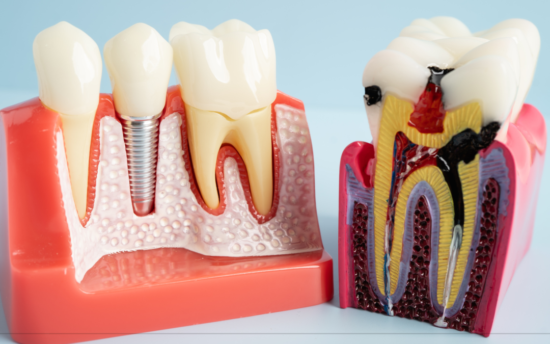 Root Canals: Step-by-Step Guide to Endodontic Treatment