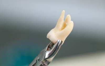 Wisdom Teeth Extractions: What Happens During Oral Surgery